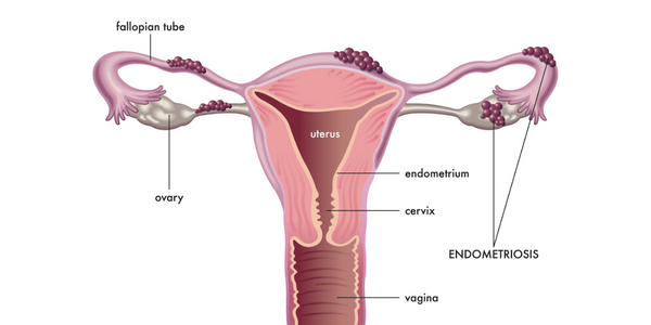 Untitled design (23) Endometriosis Treatment in Chennai
